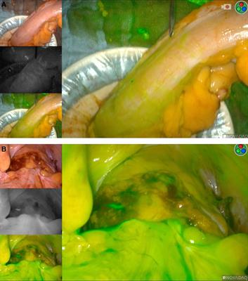 Editorial: Increasing patient’s safe in colorectal surgery via real-time bowel perfusion using near infrared ICG fluorescence studies